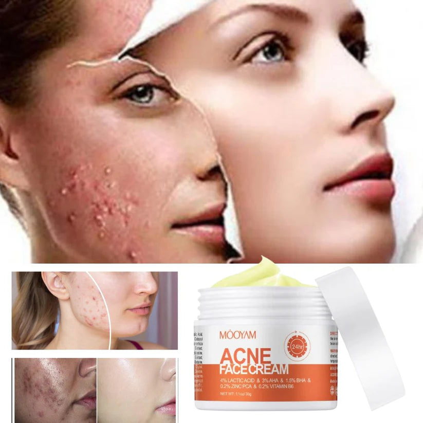 Crema para quitar el acné y las marcas