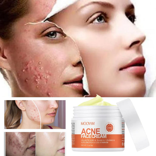 Crema para quitar el acné y las marcas